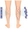 The Role of Compression Socks with a Zipper in Managing Varicose Veins