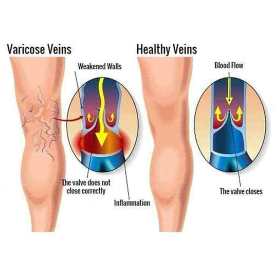 The image showcases varicose veins, illustrating a twisted vein alongside a healthy or normal vein for comparison.