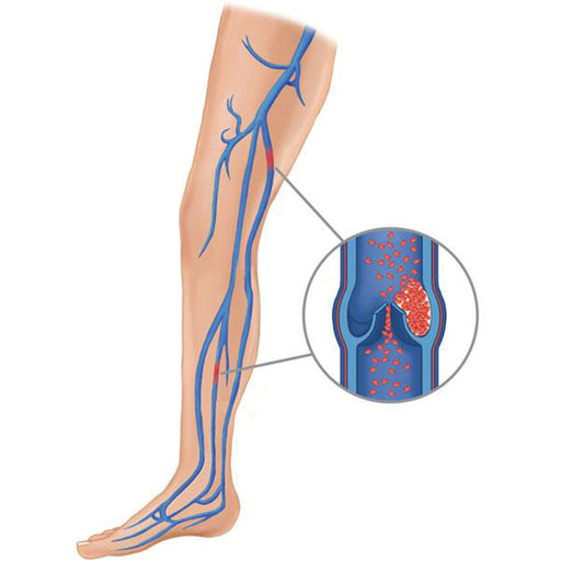 Leg vein with a blood clot.